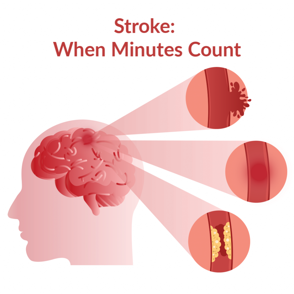 About Stroke in short For Doctors & others